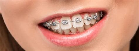 precio medio brackets metalicos|brackets invisibles precio.